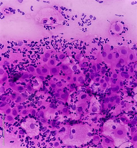 inflammatory associated cellular changes pap.